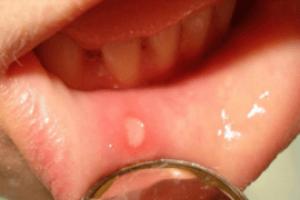 Čo je rakovina ústnej dutiny, jej prevencia, príznaky a liečba